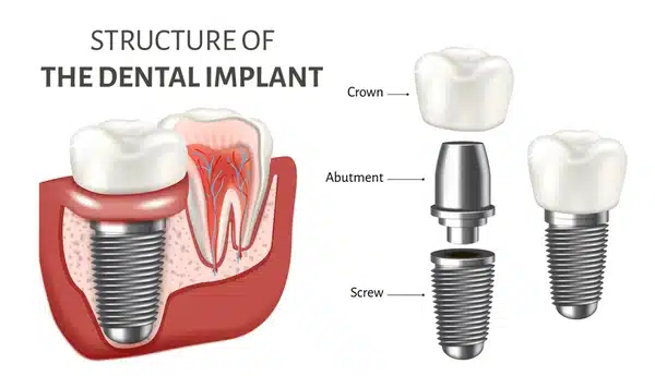 Implant Dentistry in San Diego, CA
